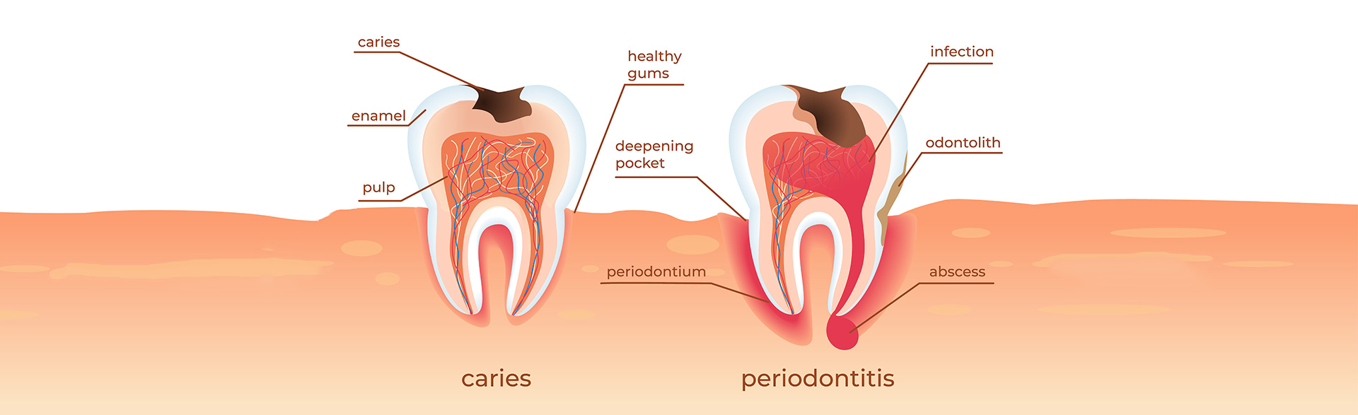 Jaw and Gum Resorption, Brush & Floss Dental Center